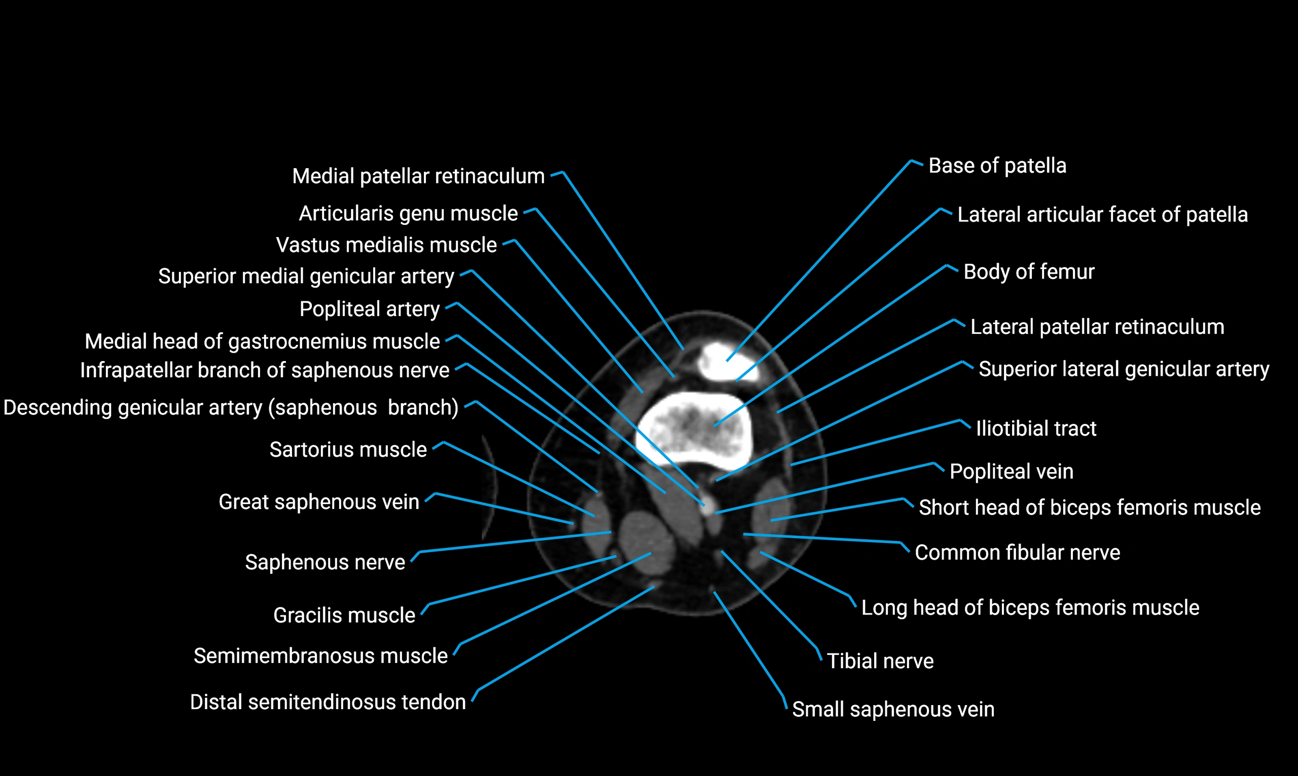 CT lower limb axial cross sectional anatomy labelled image 80 (2).webp